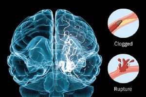 stroke