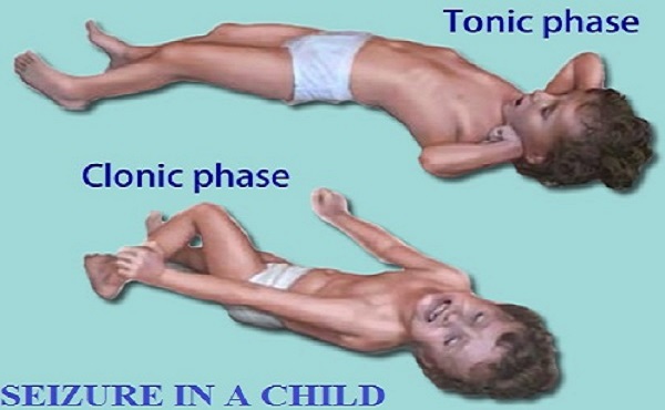 খিঁচুনী