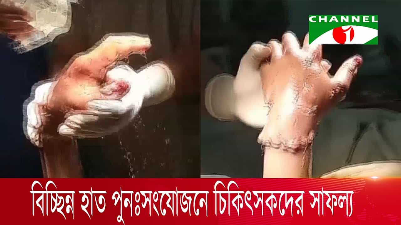 খুলনায় চিকিৎসকদের বিচ্ছিন্ন হাত পুনঃসংযোজনে সাফল্য. Channel i News - চ্যানেল আই নিউজ