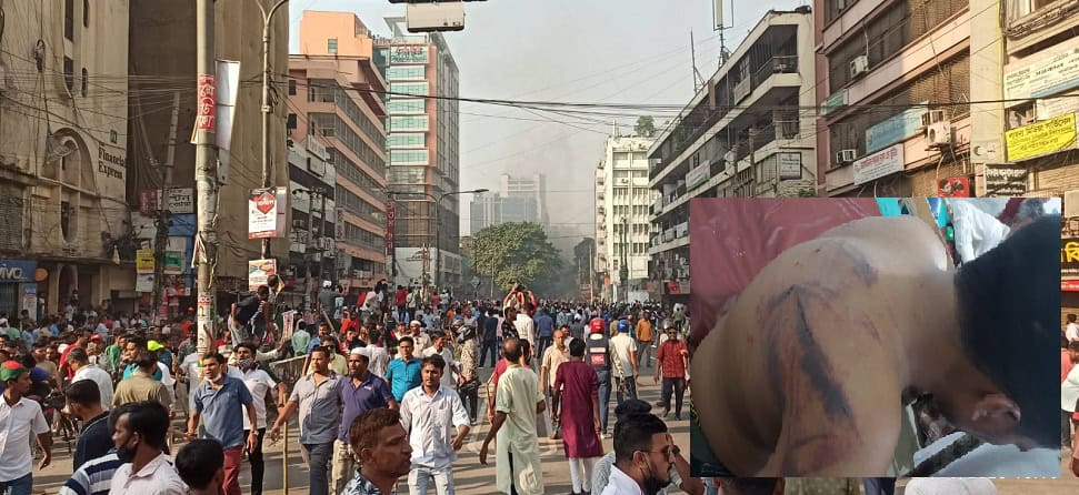 কাকরাইলে সংঘর্ষের সময় রক্তাক্ত সাংবাদিকের ছবি. Channel i News - চ্যানেল আই নিউজ