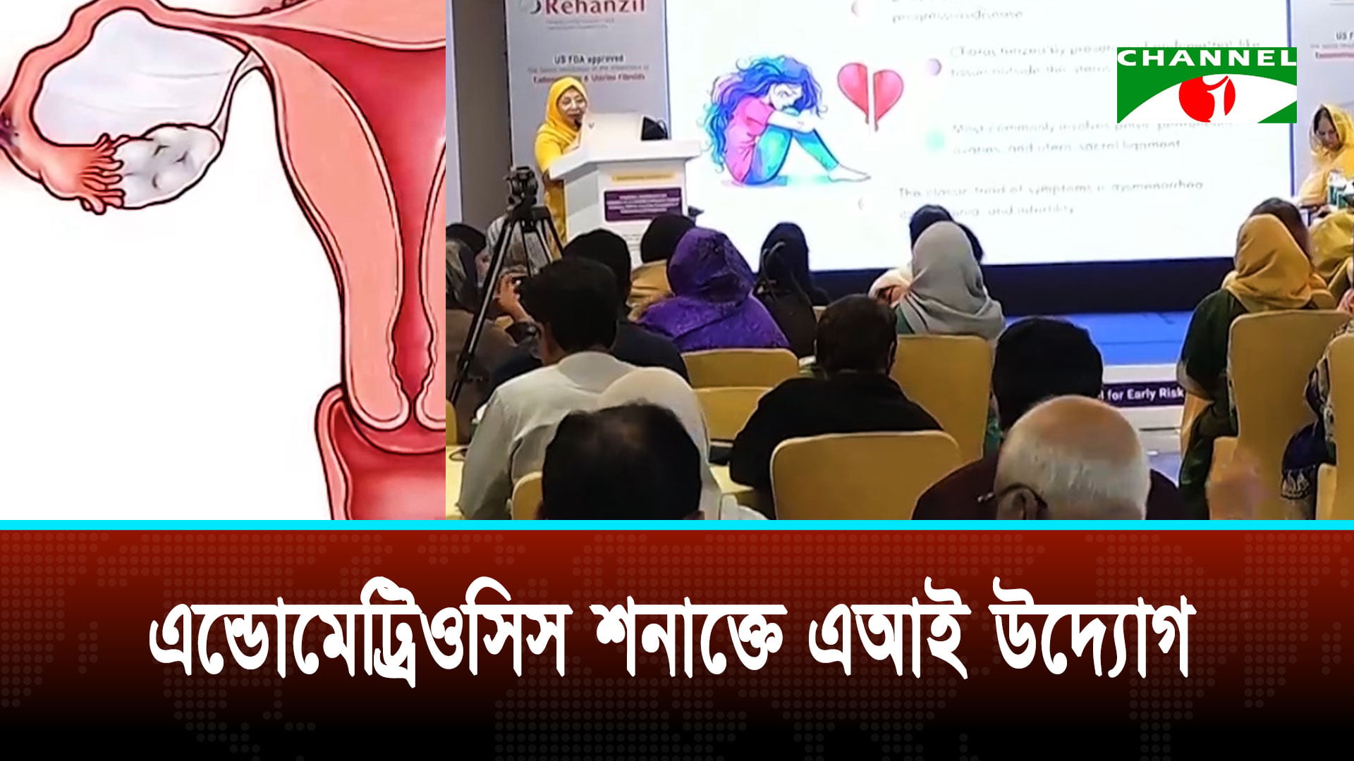 নারী প্রজনন স্বাস্থ্যের জন্য হুমকি ‘এন্ডোমেট্রিওসিস’