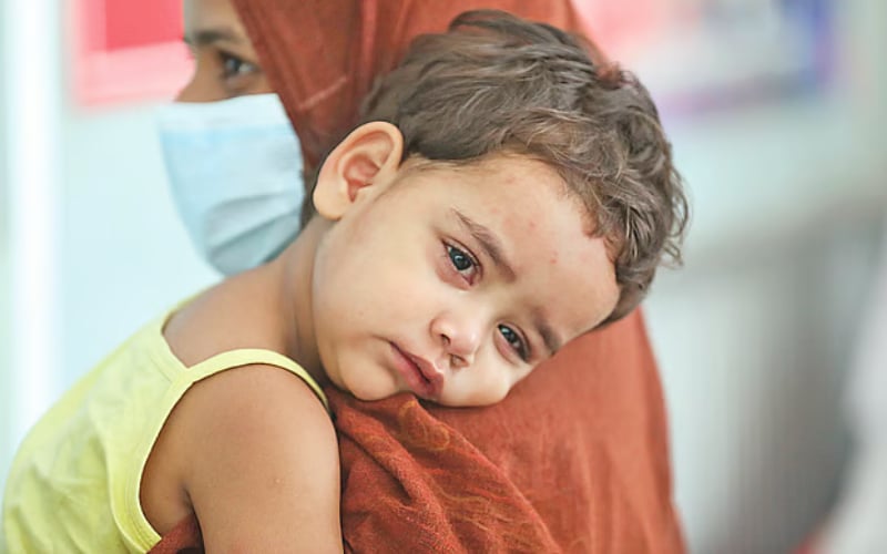 দেশে ৫৬ জেলায় ছড়িয়েছে হাম, উদ্বিগ্ন বিশ্ব স্বাস্থ্য সংস্থা