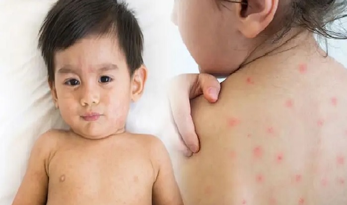 হামের সংক্রমণে শিশু মৃত্যু কেন কমছে না?