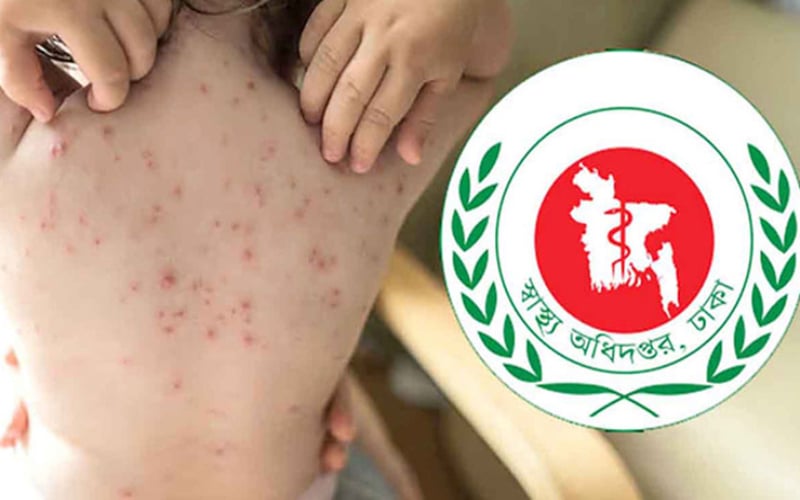 হামে আরও ৭ শিশুর মৃত্যু | চ্যানেল আই অনলাইন হামে আরও ৭ শিশুর মৃত্যু | চ্যানেল আই অনলাইন