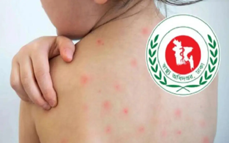দেশে হামের উপসর্গে আরও ৫ শিশুর মৃত্যু